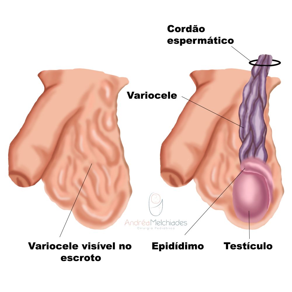 Espermatocele: o que é, sintomas, causas e tratamento - Tua Saúde